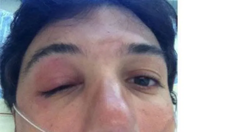Foto Fabiana Cancellary po alergické reakci