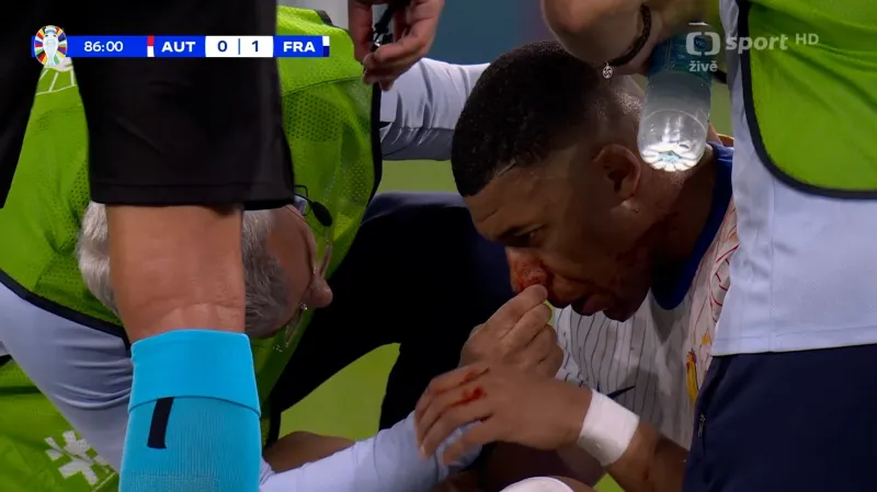 Mbappého zranění nosu a eskapáda se zdržováním hry