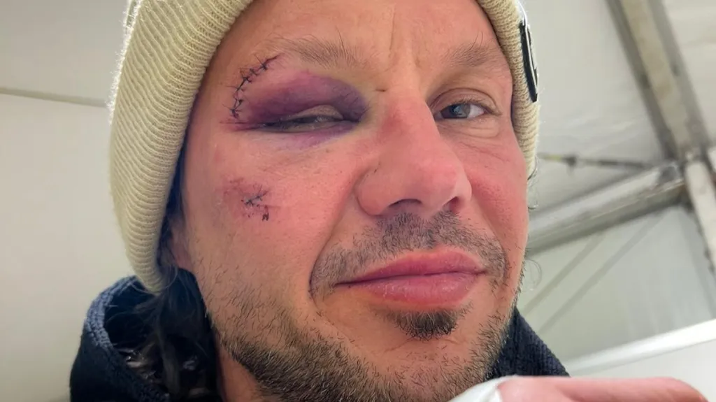 Libor Podmol po pádu ve 3. etapě Rallye Dakar