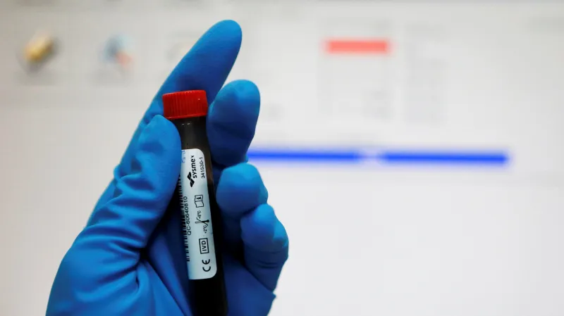 Jeden ze vzorků krevního testu v antidopingové laboratoři v Moskvě